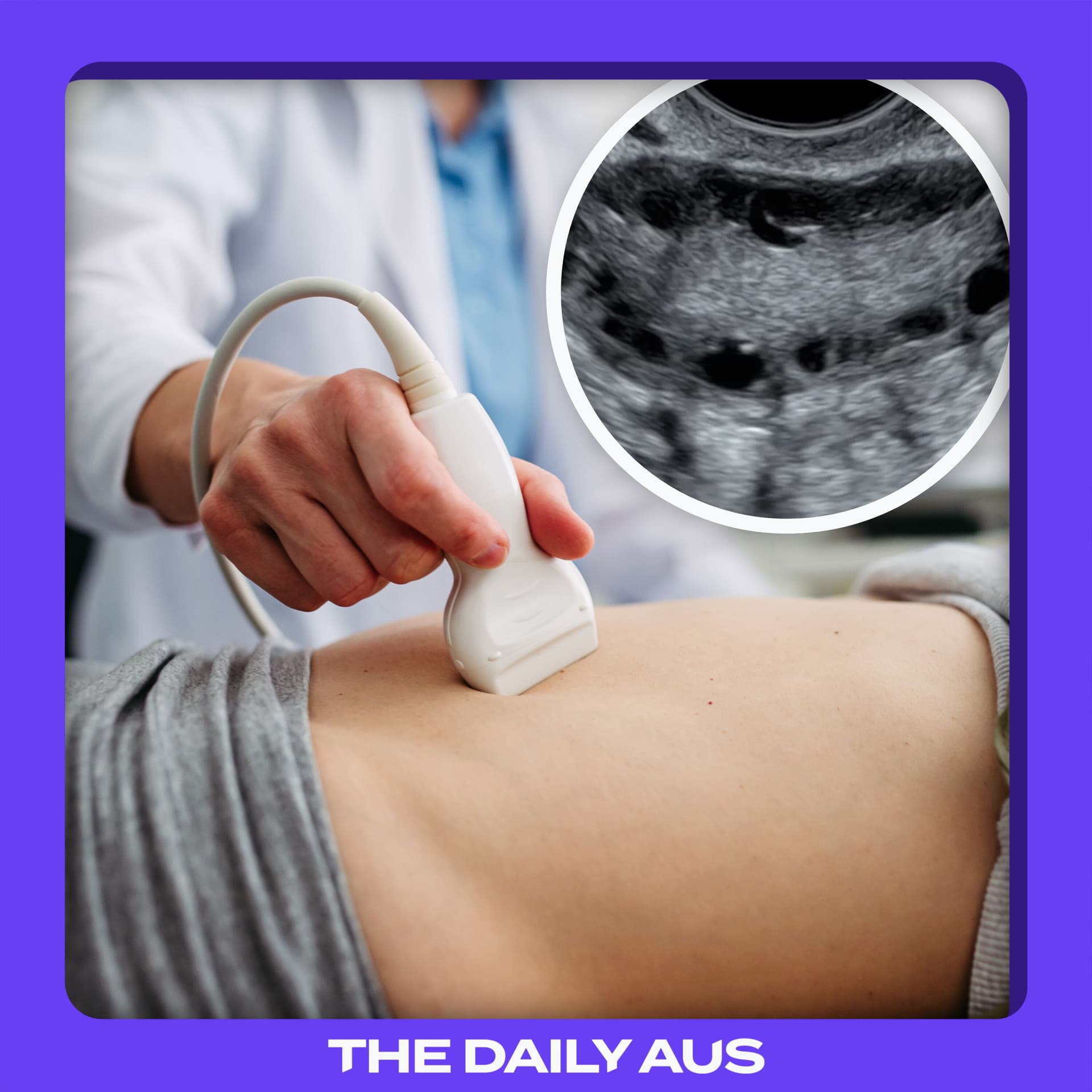 Why is PCOS getting a new name?